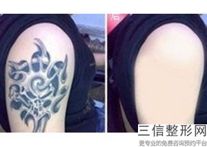 2022广州哪家医院热玛吉做的好？排行榜前四正规且有资质！
