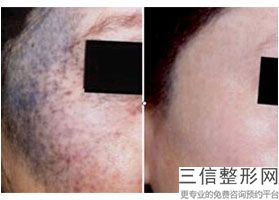 2022广州哪家医院热玛吉做的好？排行榜前四正规且有资质！