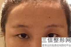 2022天津割双眼皮医院排名榜前八强权威集结！