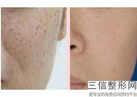 2022郑州拉皮除皱医院排名现在的人生活压力太大