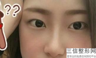 长沙割双眼皮医院排名前十的医院有哪些？