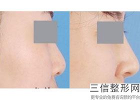 长沙哪些医院隆鼻比较好，希望能给你一个好的帮助