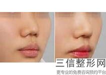 成都隆鼻医生排名前八的隆鼻外科医生是谁？