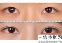 福州哪家医院做双眼皮整形比较好？福州真格医美