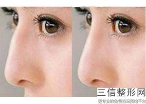 哈尔滨隆鼻医院哪家好？排名前十一的整形医院