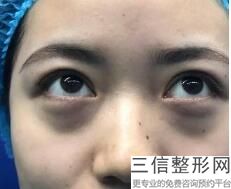 哈尔滨哪个整形医院做双眼皮好?排行榜前十合集公开!