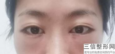 杭州有效祛眼袋整形医院排名榜前五的眼袋医院