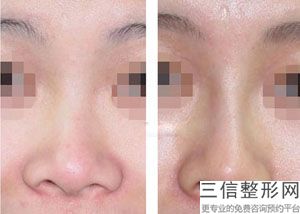 好的隆鼻整形医院有哪些？深圳美莱医疗美容医院