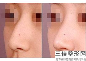 好的隆鼻整形医院有哪些？深圳美莱医疗美容医院