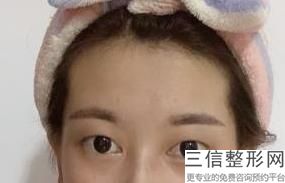 衡阳比较好的眼袋整形机构,整形效果会更好