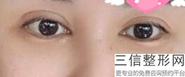 济南双眼皮整形医生排名前十名单公示！有好几位都坐诊公立