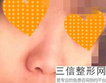 江西较新正规鼻整形医院名单，看看你是哪种？