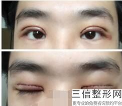 昆明割双眼皮医院排名前十昆明雅妍医疗美容诊所