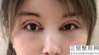 宁波去眼袋整形医院排名前十的宁波天使医疗美容诊所