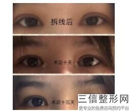 宁波去眼袋整形医院排名前十的宁波天使医疗美容诊所