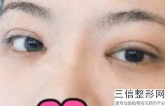 全双眼皮手术的郑州华美医疗美容门诊部