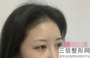 泉州的双眼皮整形医院排名怎么样？泉州西华医疗美容医院