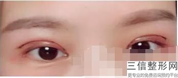 上海十大双眼皮专家排名前十上海华美杨亚益