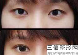 天津双眼皮医生排名前十名的天津名医供大家参考