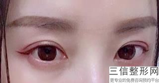 天津眼部整形医院排名前三天津河西坤如玛丽医院