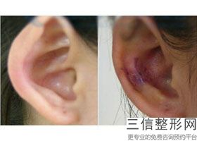 潍坊耳朵整形院排名前八，潍坊医学院整形外科