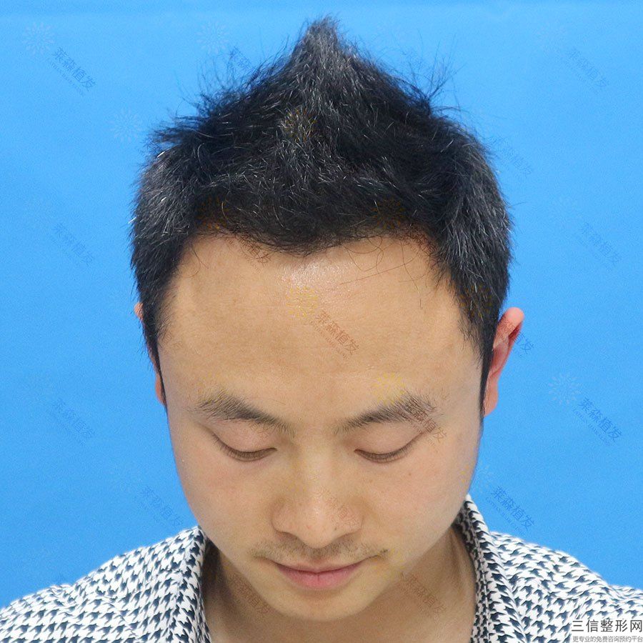温州哪些医院的植发整形项目运营实力好呢？