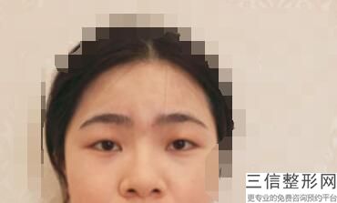 武汉做双眼皮医院排名前十一的武汉美立方