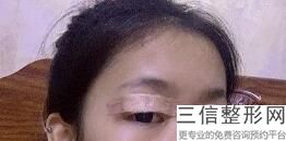 西安割双眼皮好的医院排名榜榜前十一