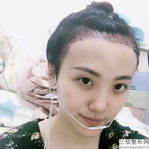 西安植发医院排名榜前八一，西安碧莲盛医院上榜
