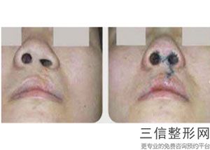 重庆隆鼻医生排名前十，你不知道如何选择医生