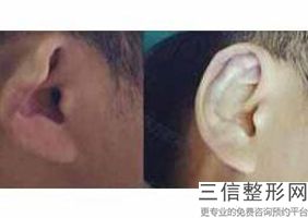 重庆自体耳软骨隆鼻哪家好？排名前八一！