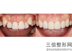 什么叫牙齿根管治疗牙齿，什么叫做牙齿的根管治疗