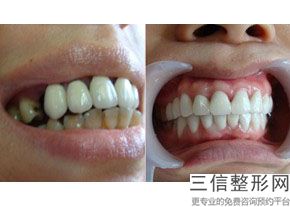 什么情况适合做烤瓷牙，做烤瓷牙的人多吗