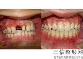 什么是仿生冠牙，美容冠矫正龅牙案例