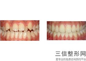 什么是仿生冠牙，美容冠矫正龅牙案例