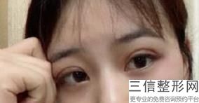 什么是开眼角手术效果图片，开眼角手术是什么样的