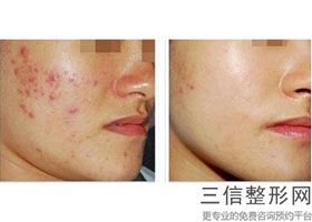 什么是音波拉皮除皱，美容电波拉皮的副作用