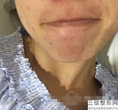 什么是音波拉皮除皱，美容电波拉皮的副作用