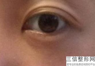 什么原因引起眼睑下垂，引起眼睑下垂的原因
