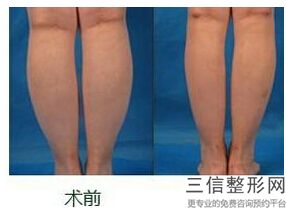 手臂吸脂凹凸不平多久能恢复，吸脂后会不会凹凸不平