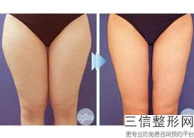 手臂吸脂术前注意事项，一般手臂吸脂后需要注意哪些呢