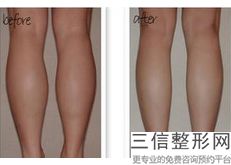 手臂吸脂吸哪个部位,手臂吸脂用哪种好
