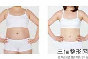手臂吸脂用哪种好,手臂吸脂要注意什么