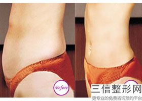 手臂吸脂用哪种好,手臂吸脂要注意什么