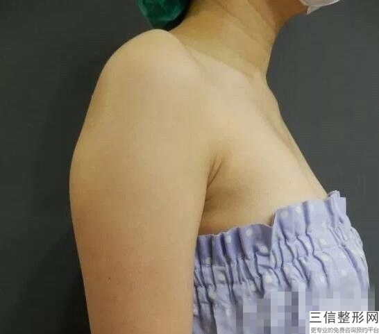 手臂吸脂有危险吗，手臂吸脂效果明显吗