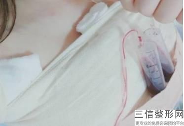手术隆胸需要多少钱，多少钱隆胸费用