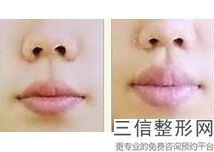 手术做嘟嘟唇要多少钱，多少钱能做M唇