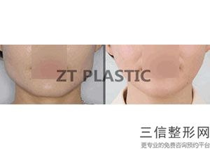 手术做嘟嘟唇要多少钱，多少钱能做M唇