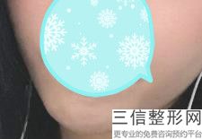 手术做嘟嘟唇要多少钱，多少钱能做M唇