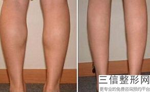 瘦大腿需要多少钱，瘦腿多少钱